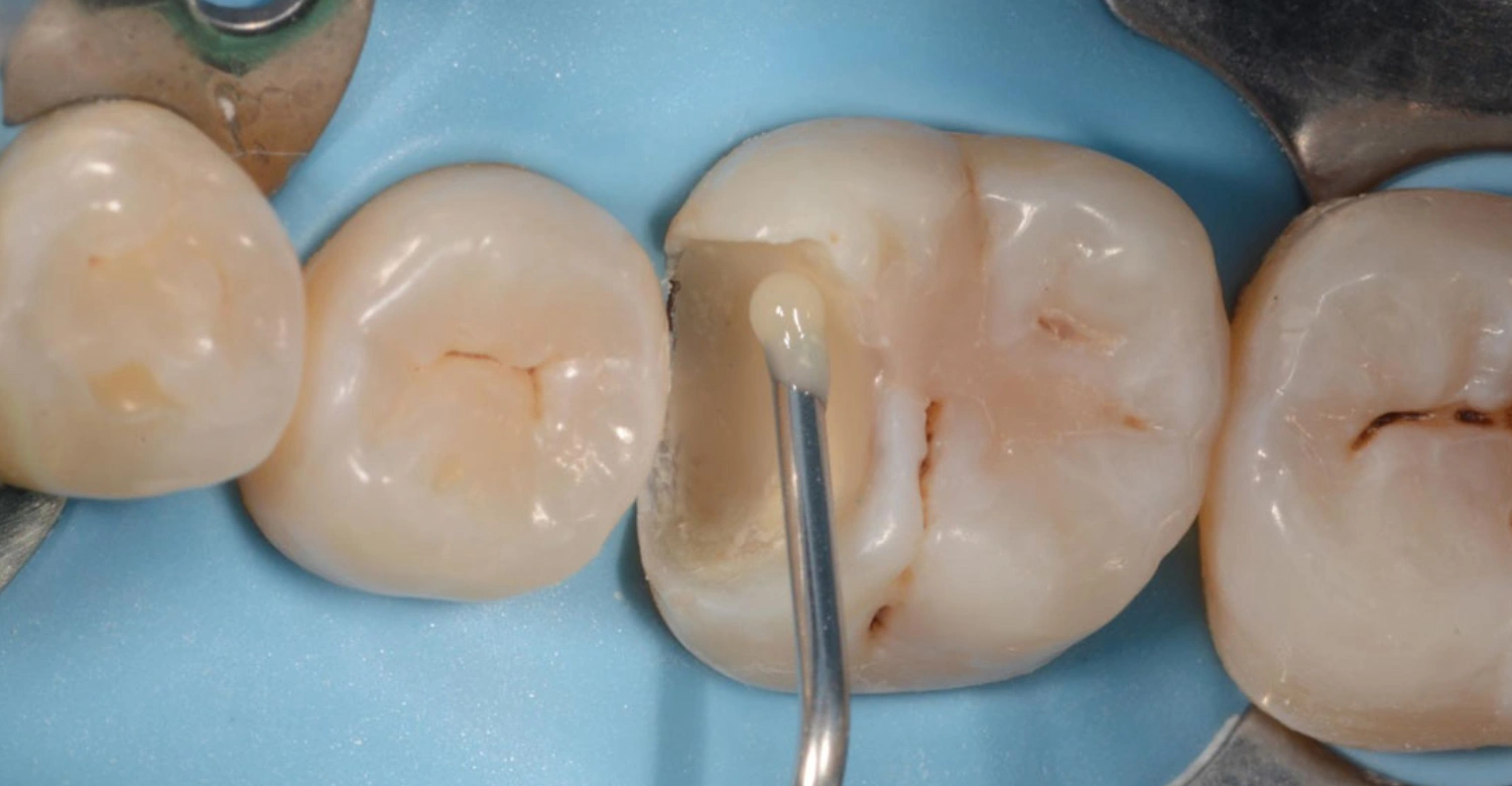 Pulp Cap dental Inblog